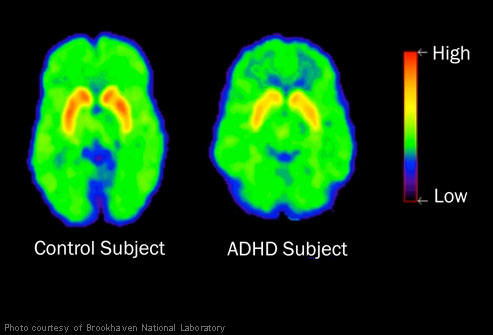 دلایل ADHD