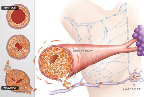 مراحل سرطان سینه 