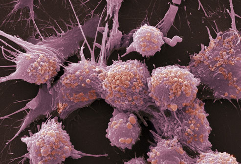 راهنمای تصویری سرطان پروستات 1
